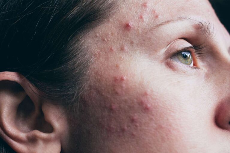 The Ultimate Guide to Active Acne Treatment: Say Goodbye to Breakouts!
