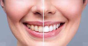 The Secret to a Whiter Smile: Exploring Professional Teeth Whitening