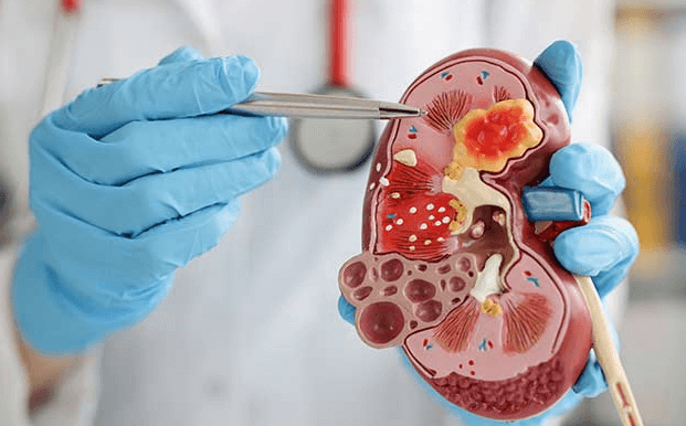 Unveiling the Expertise: What is a Nephrologist?